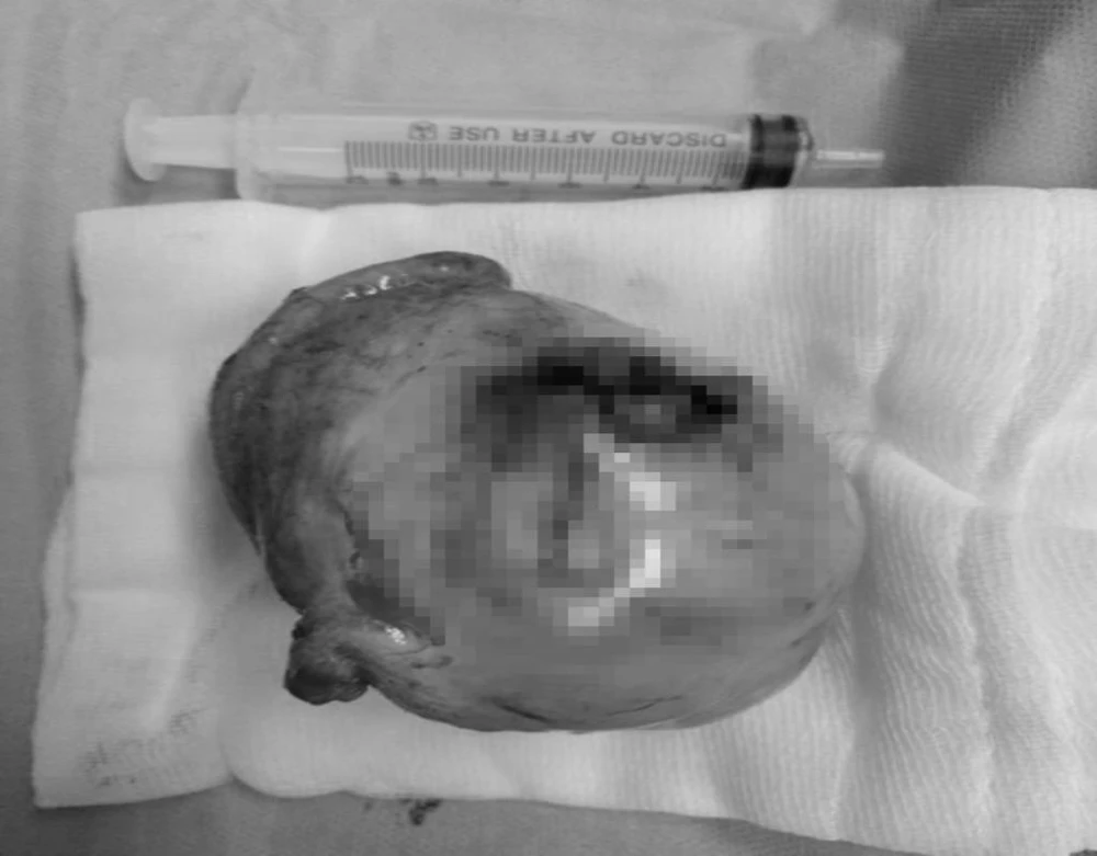 Khối u tinh hoàn to bằng trứng đà điểu