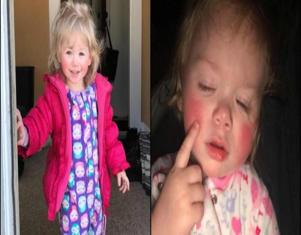 Cô bé Ivy Angerman bị dị ứng với cả mồ hôi của chính mình. 