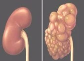 Bệnh thận đa nang và các biến chứng