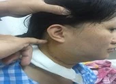 Cô gái suýt câm vì bác sĩ nhầm khối u là hạch cổ