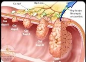 6 triệu chứng thầm lặng của ung thư đại tràng