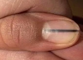 Tưởng chỉ là vết đen trên móng, ai ngờ bệnh chết người