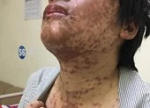 Mề đay nổi từng dề do tùy tiện uống thuốc cảm