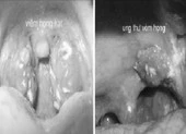 Cách phân biệt ung thư vòm họng và viêm họng