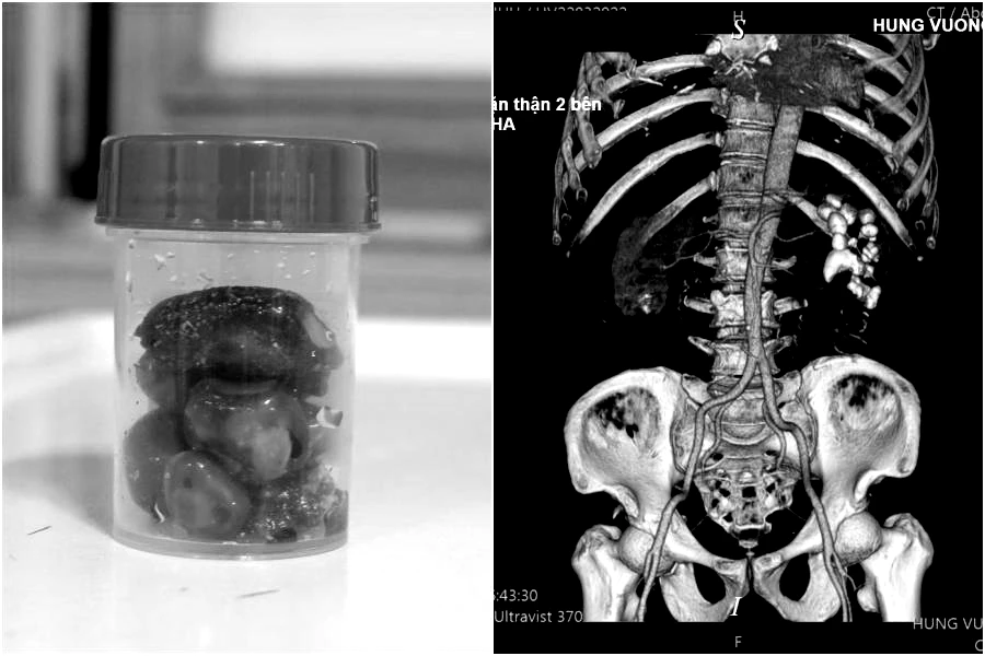 3 tháng dùng thuốc nam trị sỏi thận, nam bệnh nhân phải nhập viện gấp ảnh 1