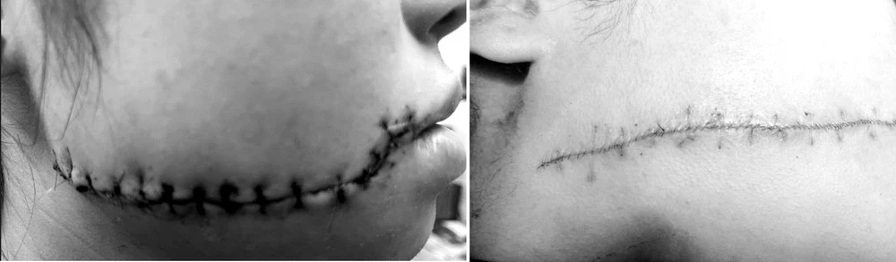 Vết rách của chị N. trước (trái) và sau (phải) khi được can thiệp. Ảnh: BVCC