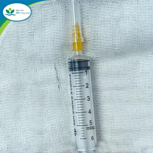 Sợi thép nhỏ nhưng rất cứng, nhọn hai đầu được các bác sĩ gắp ra. Ảnh: Bệnh viện Nhi Trung ương