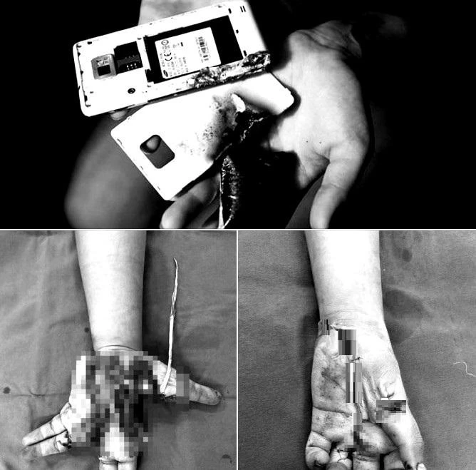 Bàn tay trước và sau phẫu thuật của bệnh nhân.