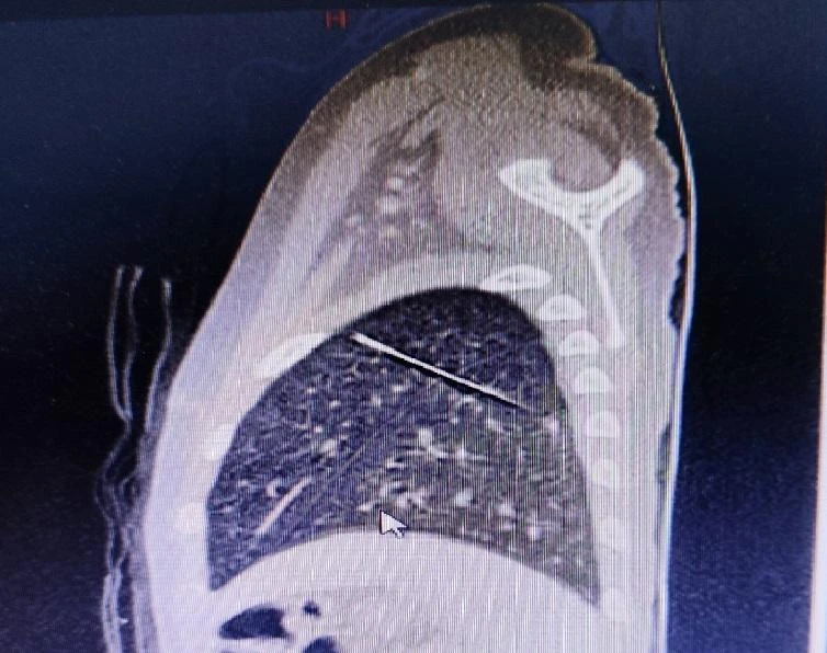 Hình ảnh dị vật là chiếc kim may nằm sâu trong nhu mô phổi trái bé T. Ảnh: BV Nhi đồng2.