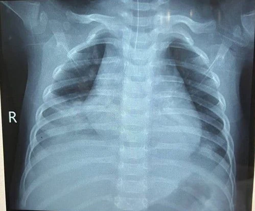 bé trai uống dầu hỏa ngộ độc nguy kịch