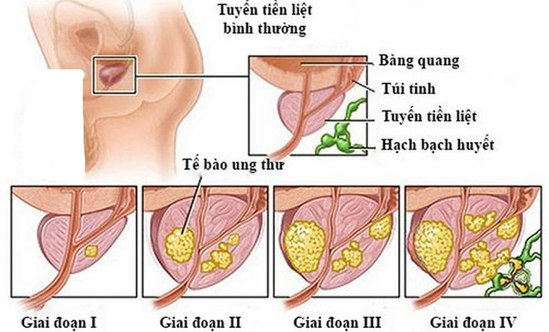 ung thư tuyến tiền liệt
