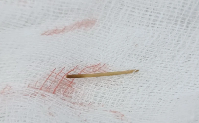 thủng ruột non nghi nuốt nhầm tăm tre