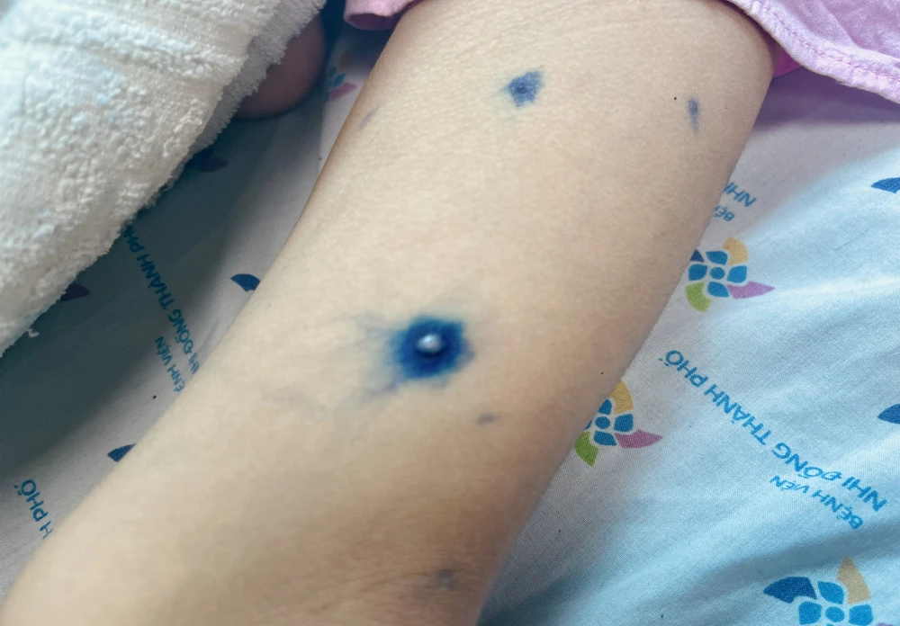 bệnh thủy đậu