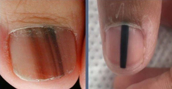 sọc đen trên móng tay