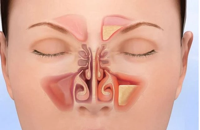 xông lá chữa bệnh viêm xoang