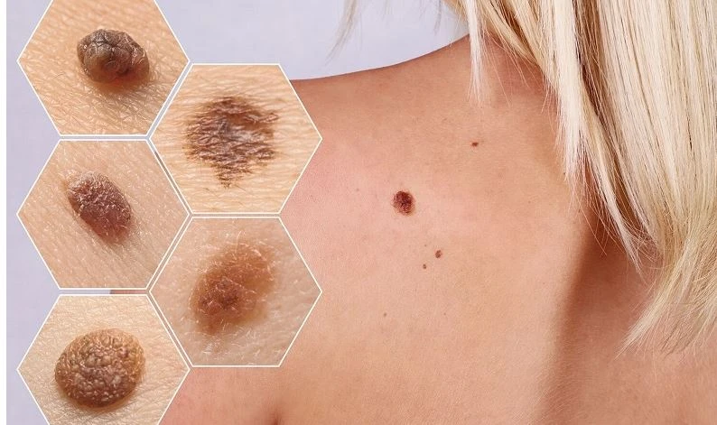 quy tắc abcde kiểm tra ung thư nốt ruồi