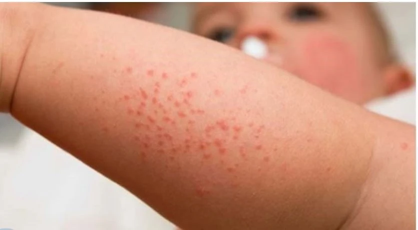 trẻ mắc bệnh sởi có tắm được không