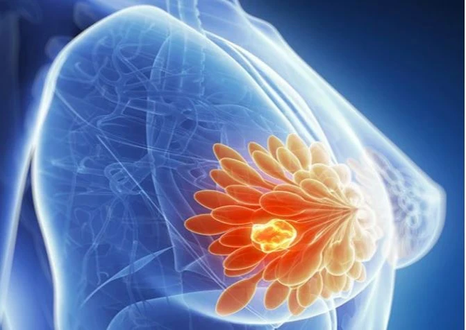 Hầu hết các u xơ tuyến vú lành tính