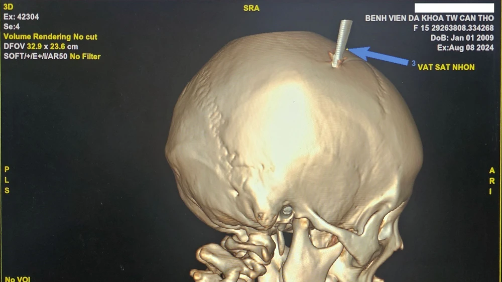 bị kéo đâm thủng hộp sọ