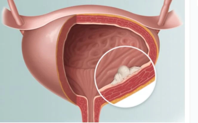 ung thư bàng quang