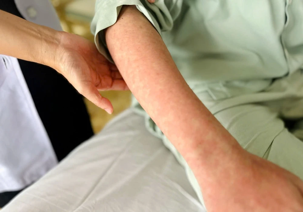 Biến chứng viêm phổi khi mắc bệnh sởi thông thường xuất hiện ở giai đoạn phát ban rầm rộ