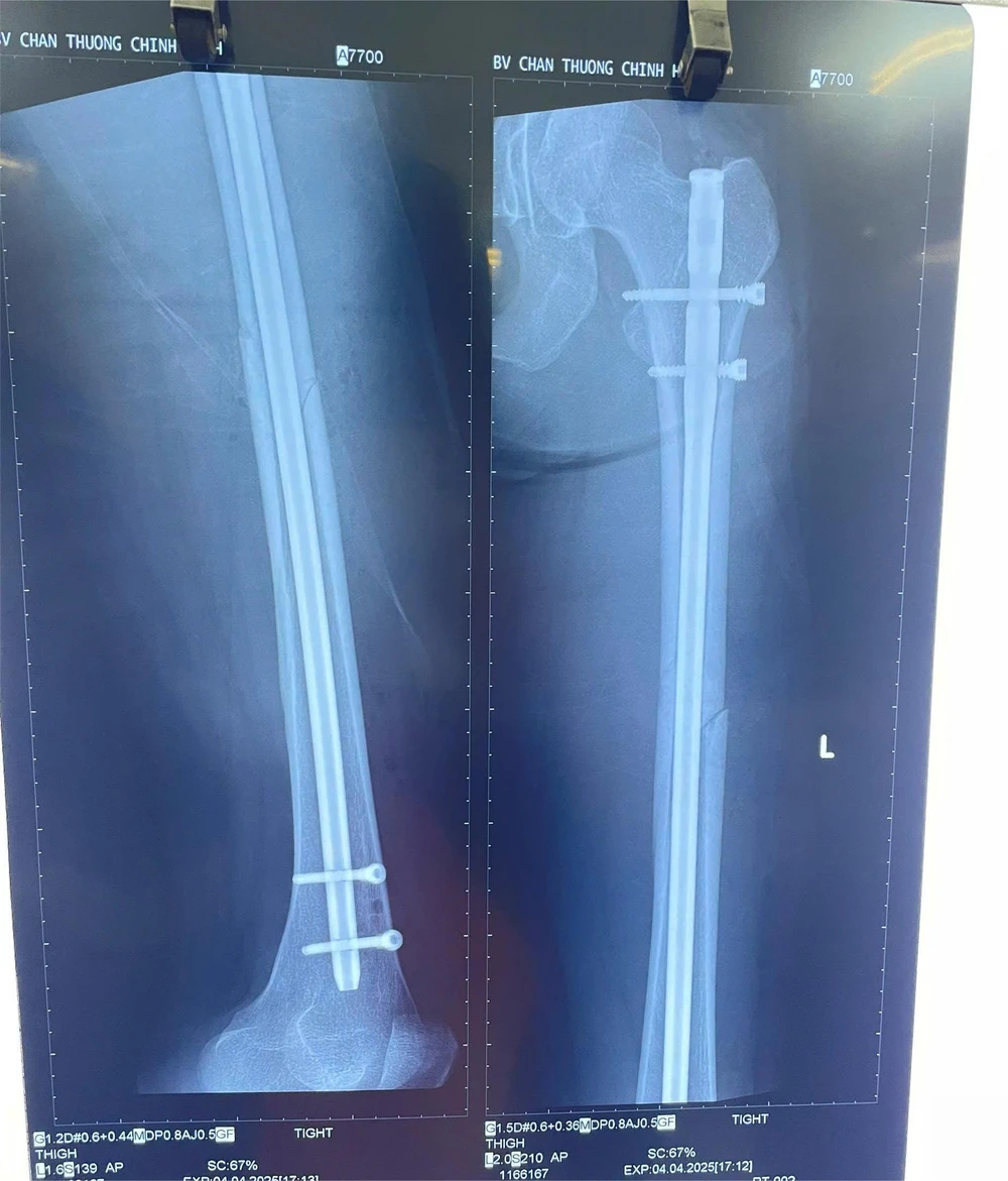 Chấn thương gãy chân