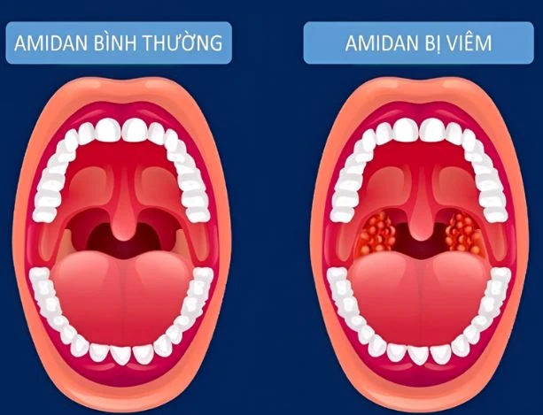 ác đợt viêm amidan cấp tính không được chữa trị triệt để có thể tái phát nhiều lần
