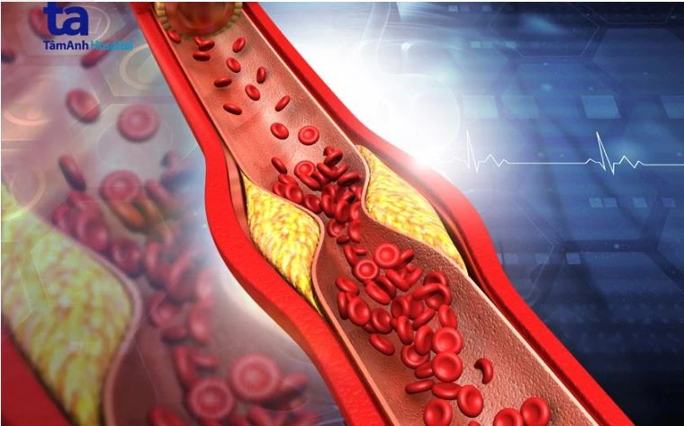 mo mau o nguoi cao tuoi.JPG