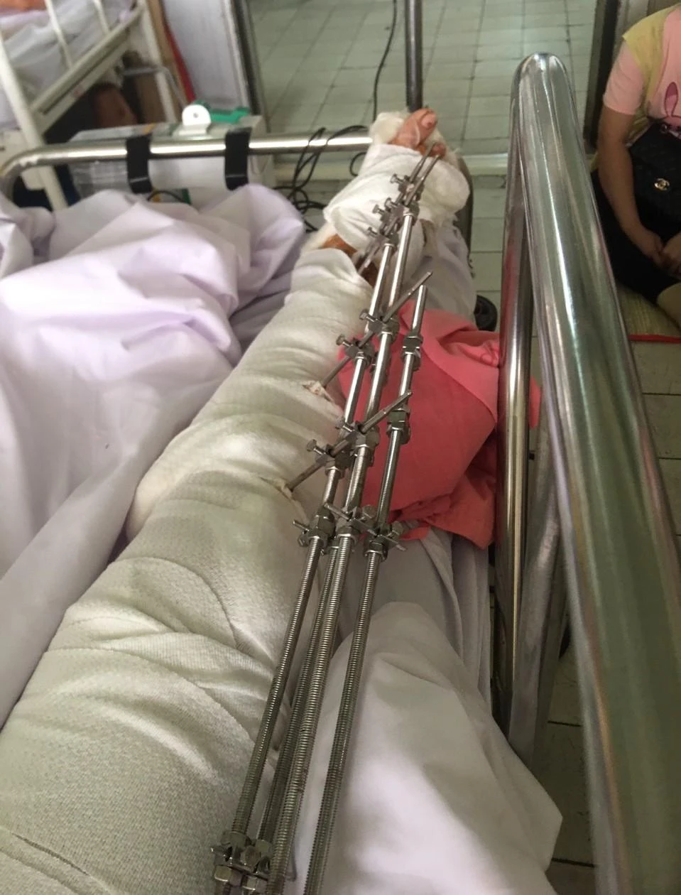 Với tình trạng thương tổn sau TNGT, bà HTMH phải nằm một chỗ, chưa thể tự vệ sinh cá nhân... Ảnh: NVCC