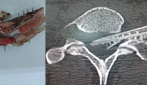 Bé 12 tuổi bị đâm liệt hai chân ảnh 1