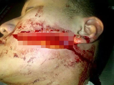 Hình ảnh vết thương đáng sợ của B. khiến nhiều người kinh hãi
