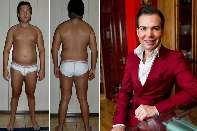 Tiếp viên hàng không suýt chết vì phẫu thuật thẩm mỹ cho giống bạn trai búp bê Barbie ảnh 2