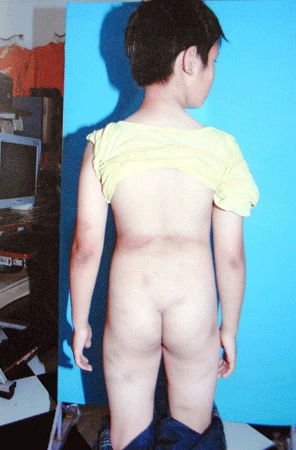 Những vết thương chằng chịt trên người cháu Hùng Anh do bị mẹ kế Hồ Thị Thảo hành hạ.