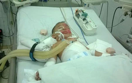 Vụ hai trẻ bị rơi xuống hồ rồi cho vào lu hơ trên lửa: Một bé đã tử vong ảnh 1 Vụ hai trẻ bị rơi xuống hồ rồi cho vào lu hơ trên lửa: Một bé đã tử vong ảnh 1