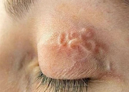 Giun bò loằng ngoằng dưới da ở mí mắt.