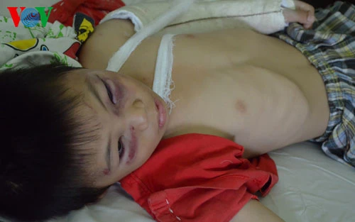 Bé trai bị cha dượng đánh gãy 2 tay chân bị nứt hộp sọ ảnh 1