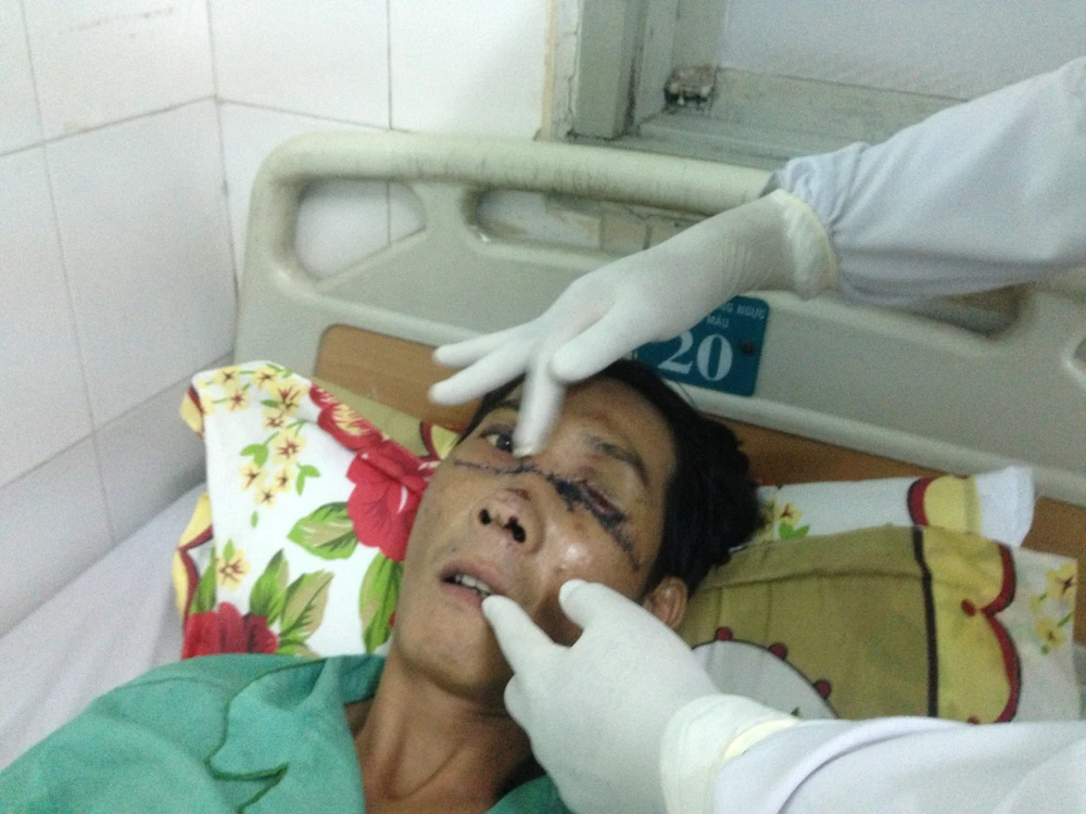 Gãy đôi xương mặt, múc bỏ nhãn cầu trái vì nổ bánh 'xe rùa' ảnh 1