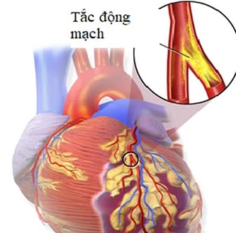 Mô hình: Tắc động mạch vành nuôi tim dẫn tới hoại tử cơ tim do động mạch đó cung cấp máu.