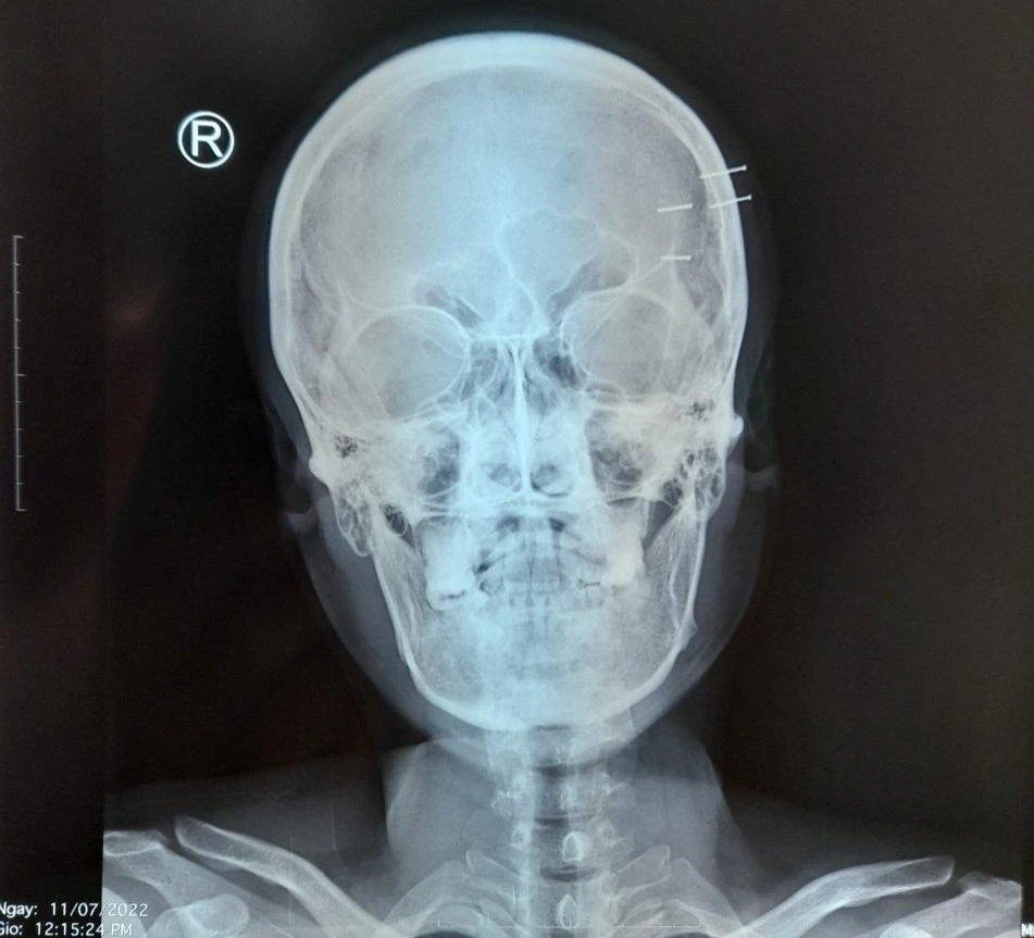 Ảnh chụp X-quang bốn cây đinh ghim vào hộp sọ. Ảnh CTV