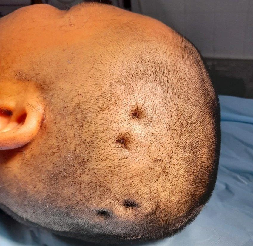 Cách giải sầu mà ông H chọn là tự lấy máy bắn đinh bắn vào đầu mình. Ảnh CTV