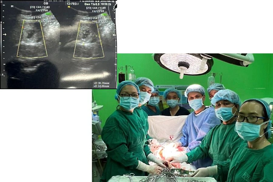 Hình ảnh siêu âm thai bám vào phân thùy của gan và êkíp thực hiện ca phẫu thuật thai bám vào gan. Ảnh: HL