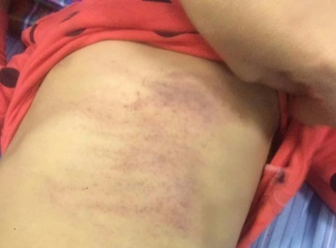 Giám định vết thương bé gái mầm non bầm tím khắp người ảnh 2