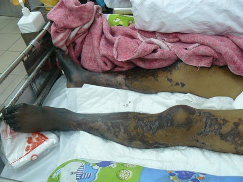 Ăn tiết canh lợn: Sướng một lần, mất một đời