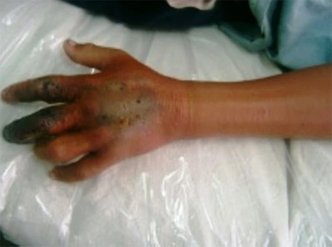 Một trường hợp bị rắn cắn