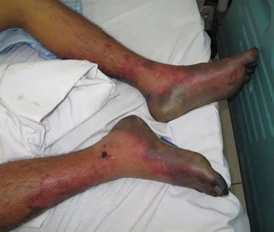 Món chạo làm từ xương, thịt lợn sống: Viêm não viếng thăm ảnh 3