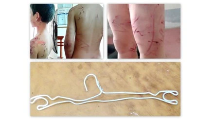Cháu N. bị bố đánh dã man bằng chiếc móc quần áo bằng sắt vì lỡ lấy cắp tiền của bà nội