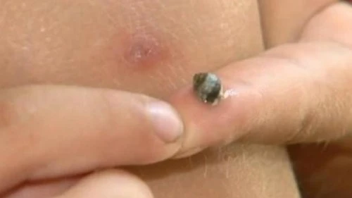 Hãi hùng ốc sên biển 'sống' trong đầu gối bé trai - ảnh 2