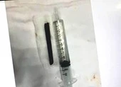 Bị đâm nửa chiếc đũa 9 cm vào mũi, sau 4 năm mới hay