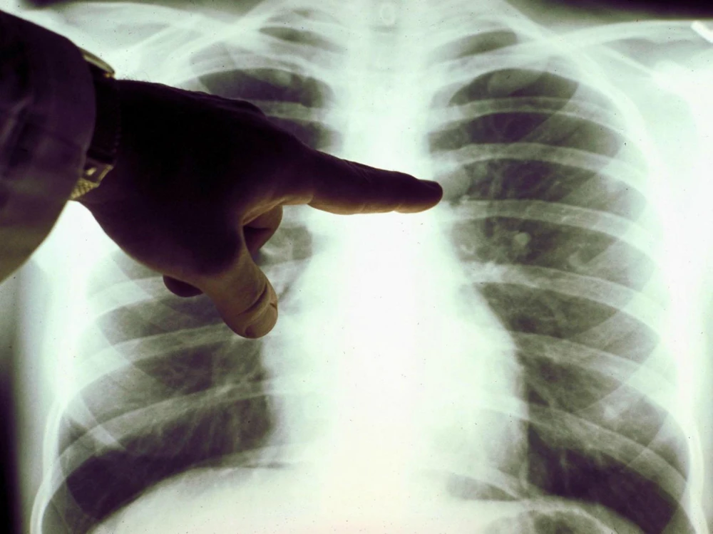 Ảnh 1: Hình ảnh lá phổi bị ung thư. Ảnh: INDEPENDENT