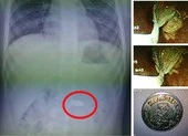 Mải chơi game, bé trai 7 tuổi nuốt đồng xu vào bụng